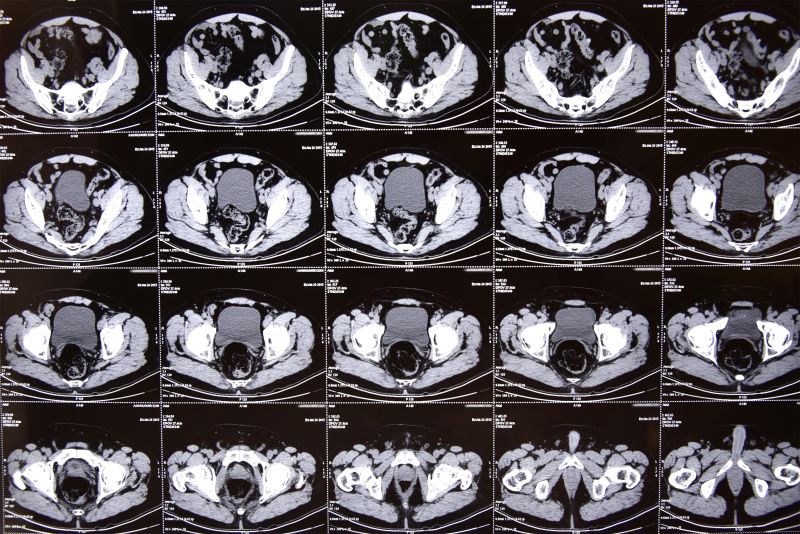 Could CT Scans Cause Cancer CNN   160106155045 Cat Scan Stock 