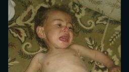 This image of a hungry child was posted on social media by a local resident in the Syrian town of Madaya. CNN cannot independently verify the image.