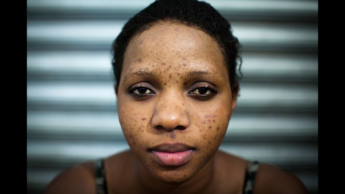 Sharifa came to Mama Lususu because of pimples, a common side effect of at-home bleaching.