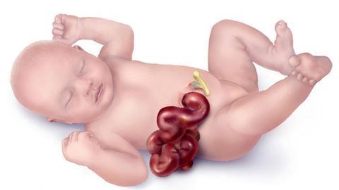  CDC researchers say there's an increase in the birth defect gastroschisis, which can cause the intestines to poke through a newborn's abdomen.