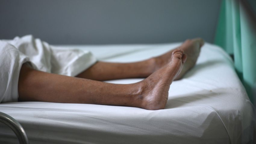 The legs of a patient suffering from Guillain-Barre syndrome recovers in the neurology ward of the Rosales National Hospital in San Salvador on January 27. Researchers are looking into a possible link between Zika and Guillan-Barre syndrome, a rare disorder that causes the body's immune system to turn on its nerves.