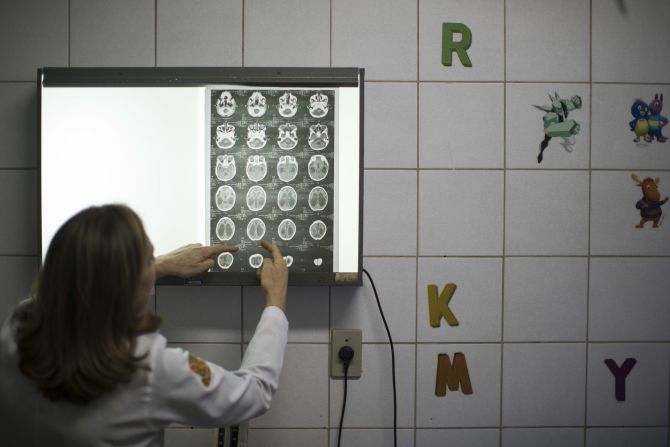 Dr. Angela Rocha shows brain scans of a baby born with microcephaly at the Oswaldo Cruz Hospital in Recife on Thursday, January 28.