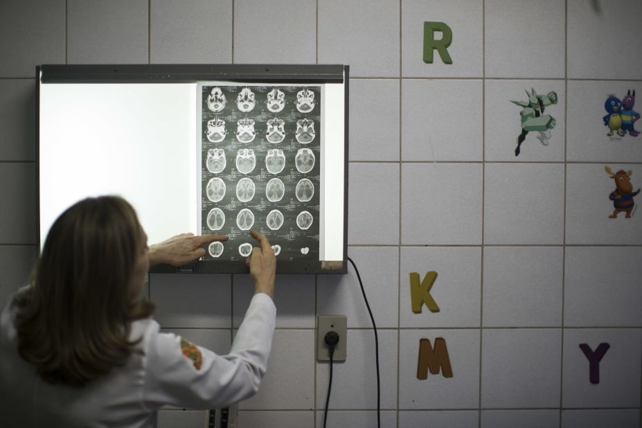 Dr. Angela Rocha shows brain scans of a baby born with microcephaly at the Oswaldo Cruz Hospital in Recife on Thursday, January 28.