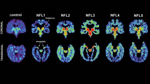 Living brain scans of five former NFL players, including Fred McNeill.