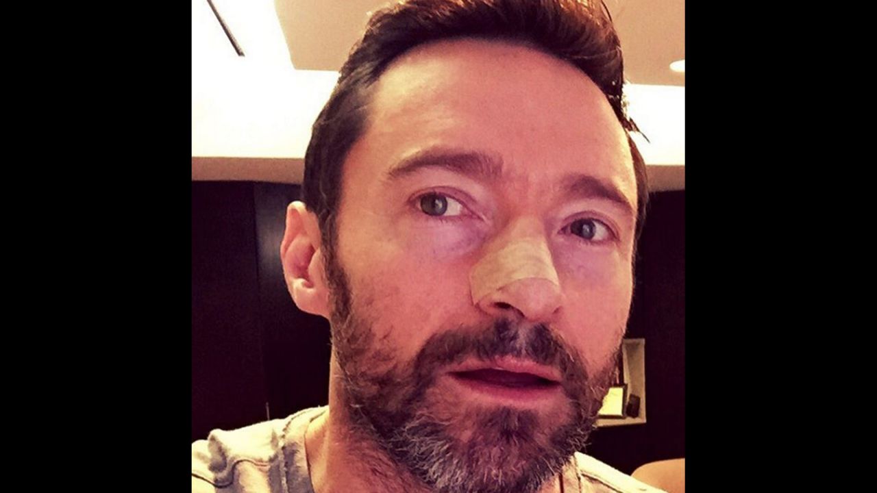 "An example of what happens when you don't wear sunscreen," <a href="https://www.instagram.com/p/BBh_iM9ChL6/" target="_blank" target="_blank">warned actor Hugh Jackman</a> on Monday, February 8. "Basal Cell. The mildest form of cancer but serious, nonetheless. PLEASE USE SUNSCREEN and get regular check-ups."