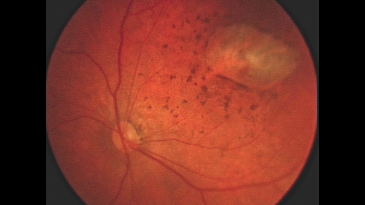 Small, dark, oblong spots dot the eye of this 1-month-old Brazilian boy born with microcephaly.