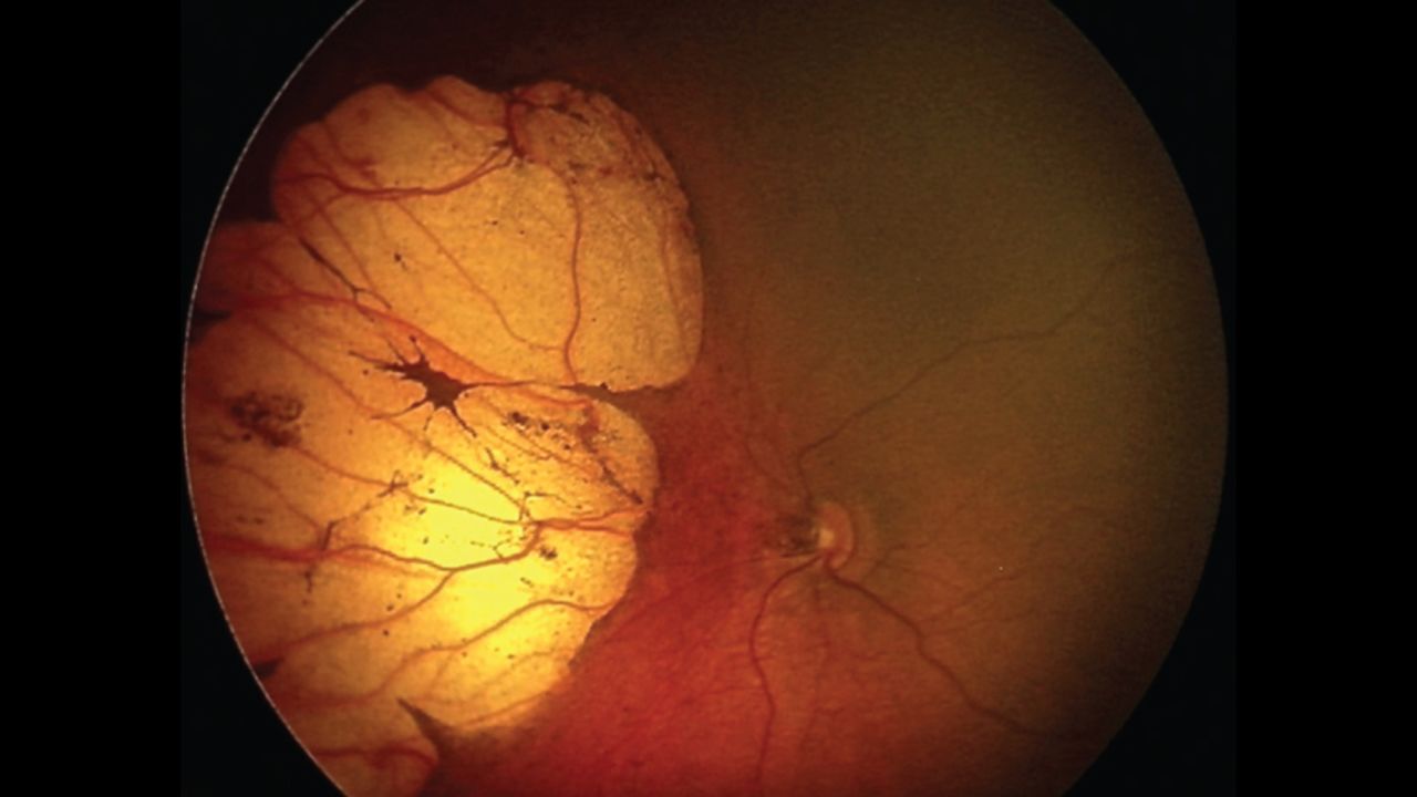 A huge lesion on the retina of a 20-day-old infant born with microcephaly.
