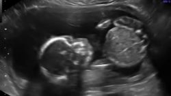 ultrasound baby punch himself kansas pkg_00010709.jpg