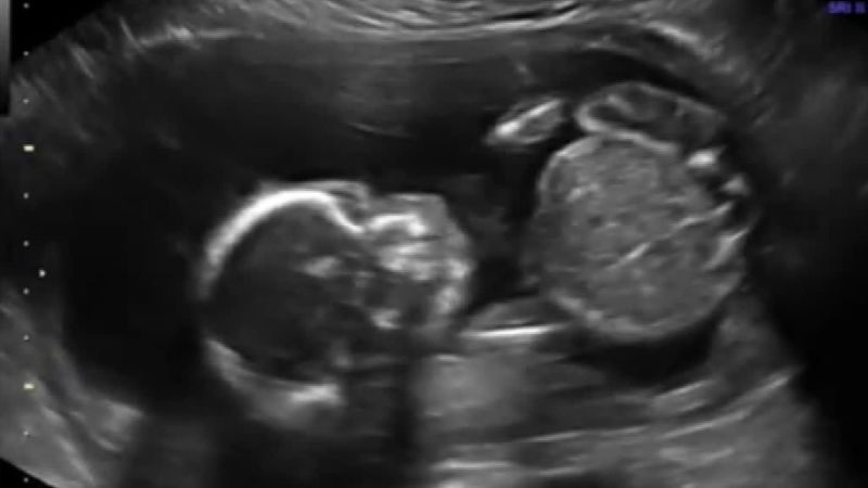 Unusual ultrasound goes viral | CNN