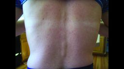 The rash on Chilson Foy's back, documented as part of the research.