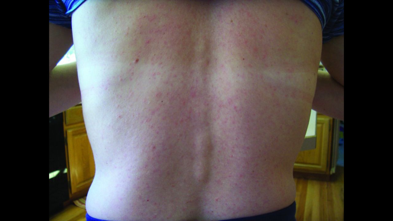 The rash on Chilson Foy's back, documented as part of the research.