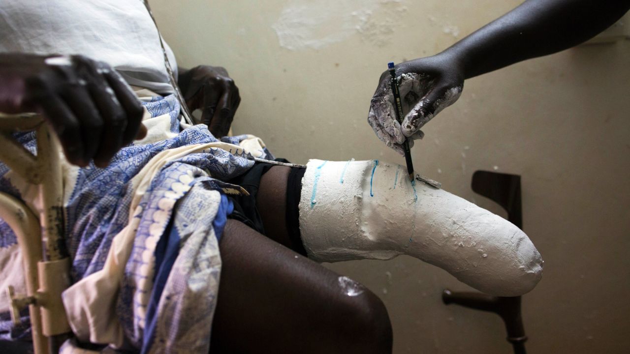 Merceliuna Atiye, a woman from Yei, South Sudan, has her amputated leg measured for a prosthetic on Monday, February 22. She lost her leg in a landmine accident years ago.
