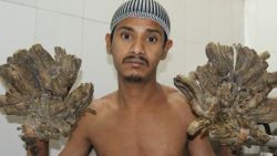 Abul Bajandra, Bangladesh's so-called "Tree Man" is suffering from an extremely rare genetic condition known as Epidermodysplasia Verruciformis.
