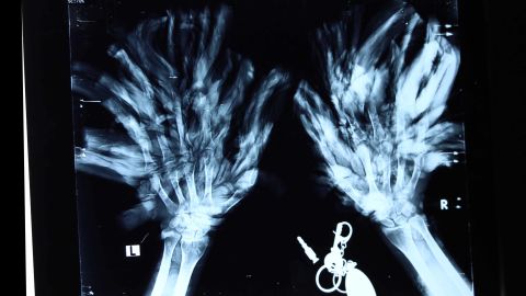 An x-ray image of Bajandra's hands. The president of the Society of Plastic Surgeons in Bangladesh arranged to have him brought to the country's capital and the government will bear the cost of his treatment.  