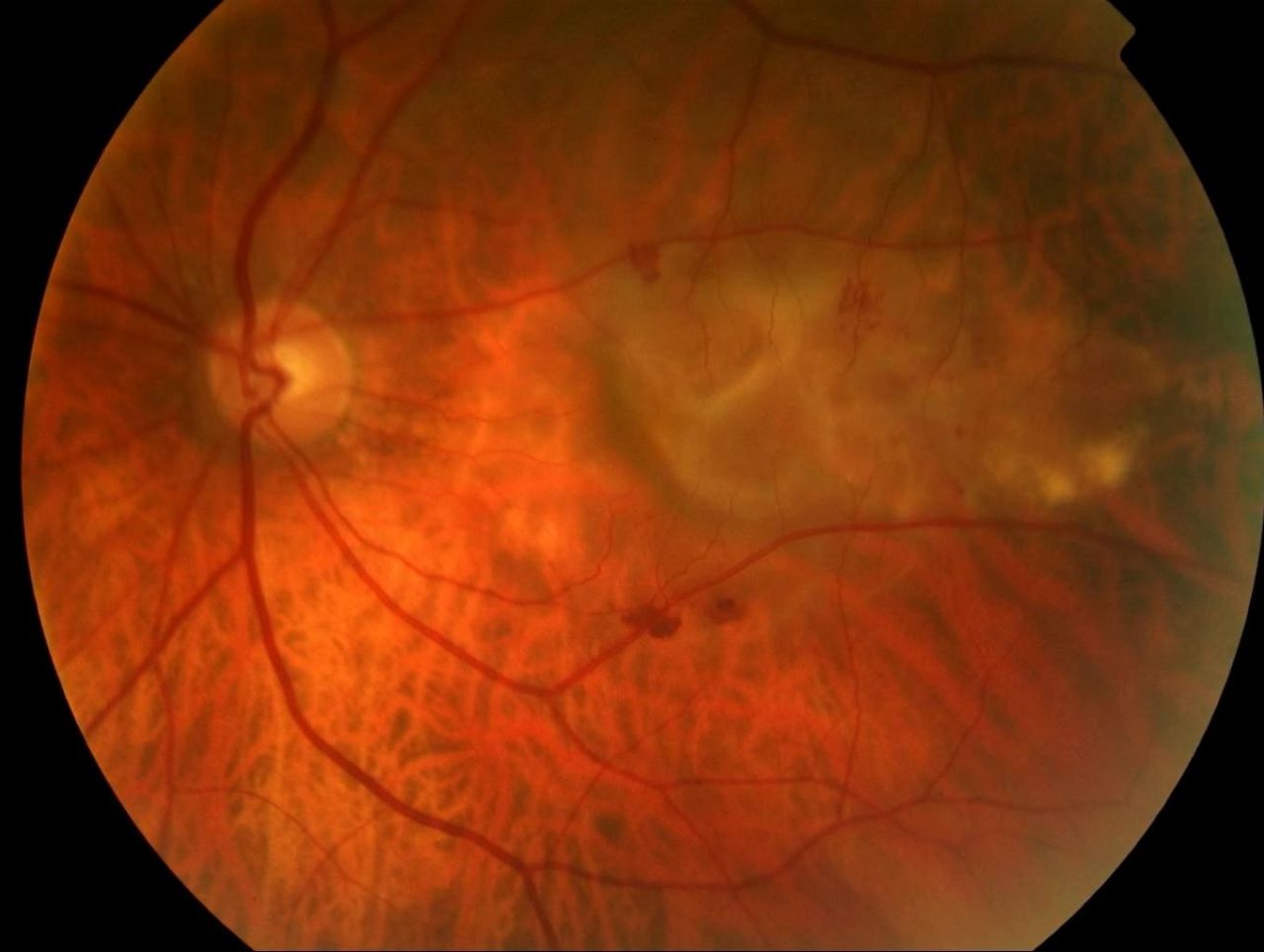AMD affects an estimated 15 million people in North America and up to 30 million worldwide. Pictured, a severe form of Age-related Macular Degeneration (AMD) seen from the back of the eye. 