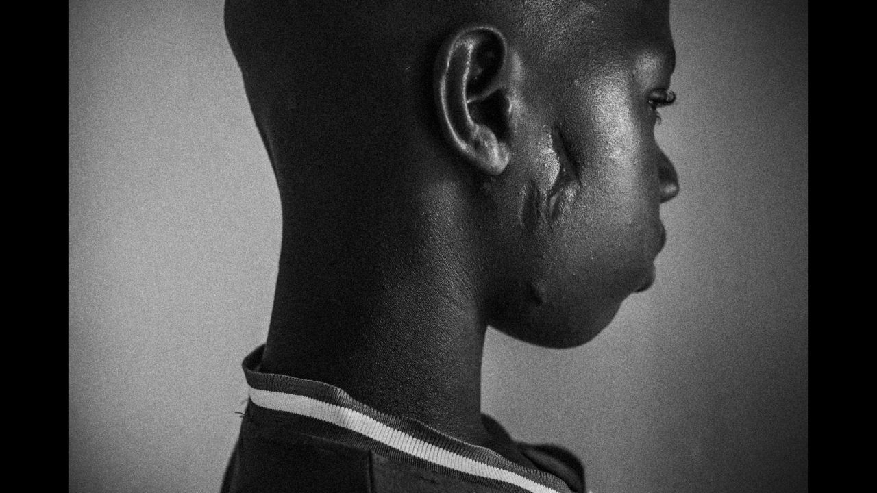 Demba Fati, 14, is photographed outside the medical support room of Mason de la Gare, a local group that helps talibés in St. Louis, Senegal. Demba's marabout beat him with an iron rod after he tried to escape. Since then, he goes to Mason de la Gare whenever he needs medical care.