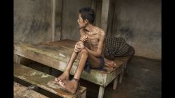 Before he died, this man lived chained to a platform at Kyai Syamsul's center in Brebes, Central Java. While there his ankles swelled, his body became emaciated. © 2012 Andrea Star Reese for Human Rights Watch
