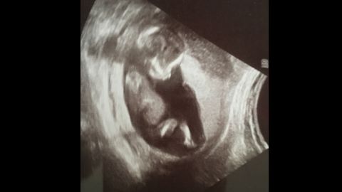 An earlier ultrasound of the Mehta's unborn child.