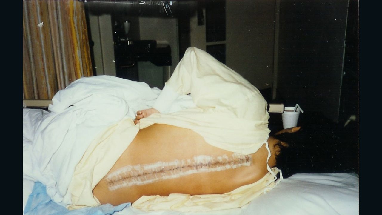 At 12, Jeanette Lee was diagnosed with scoliosis and underwent surgery to correct it. Overnight she grew 3 inches.