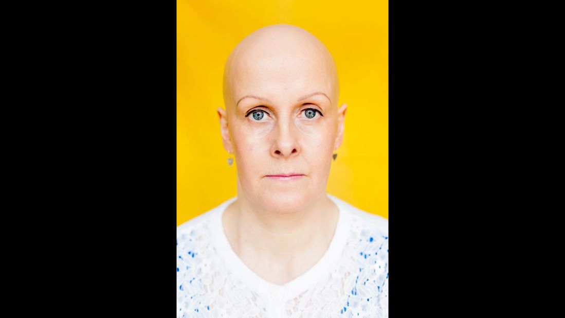 Gwennan runs an alopecia support group in Cardiff, Wales. "I tried wigs, and for a couple of years it was a confidence tonic to me," she told Soeder. "I felt happier and more able to face the world, because I was normal again. No one noticed me as I blended in with everyone else. Unfortunately for me, this was short-lived. I am not saying that this is necessarily true for others. Wigs work for so many people, but for me it led me to believe that I was hiding my identity."