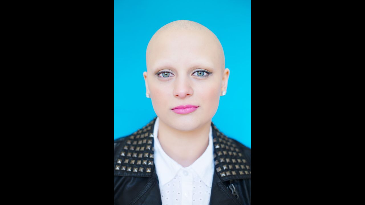 Gabrielle was diagnosed with alopecia when she was 4 years old. She hadn't met anyone else affected by the condition until this project, when she met Emily P. (from photo No. 3).