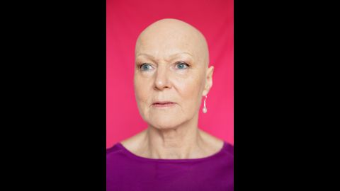 "In my 40s, I started to lose (my hair) -- just a small patch about the size of a 10p coin which grew back," Sally told Soeder. "Then another, then a bigger patch. The doctor and hairdresser said not to worry, worrying makes it worse. For 15 years, I spent a fortune on creams, shampoos and pills to make it grow -- but nothing worked for long. And when it did grow back, it was pure white. So hair dye became my best friend. Life became a constant struggle to hide the bald bits. I felt at war with my hair."