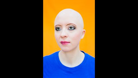 Victoria lost her hair when she was 21. She founded the PrettyBald organization to provide the support that she couldn't find.