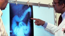 390487 08: (FILE PHOTO) A doctor goes over a patient''s x-ray, screening for colon cancer. There is no single cause of colon cancer. Cancer of the colon and rectum accounts for 15% of cancer deaths. (Photo by American Cancer Society/Getty Images)