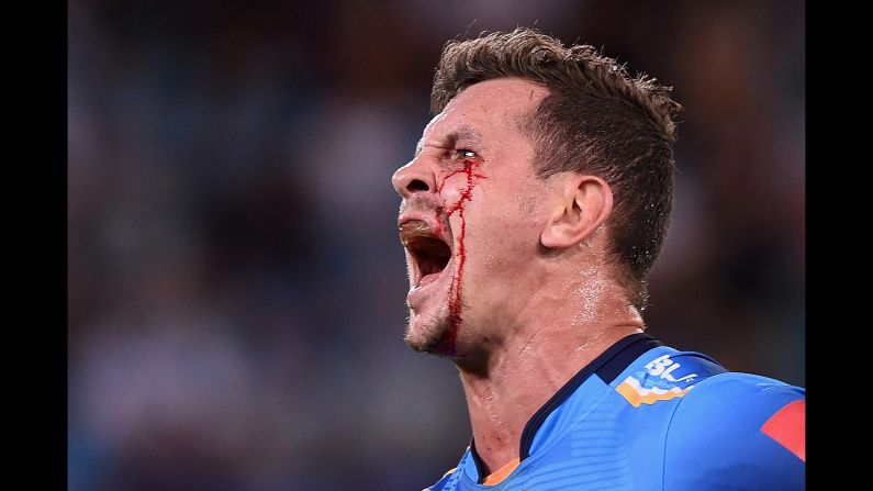 Greg Bird suffered a cut to the face during a National Rugby League match in Gold Coast, Australia, on Friday, April 1.