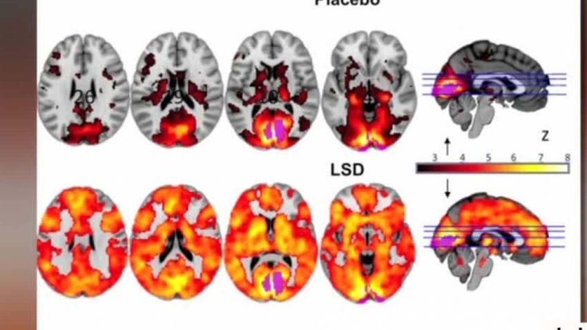 effects of lsd on human brain curnow intv_00003204.jpg
