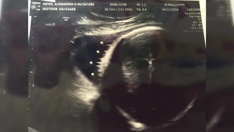MIL Acts Suspicious After Expectant Mother's Sonogram Photos Go Missing