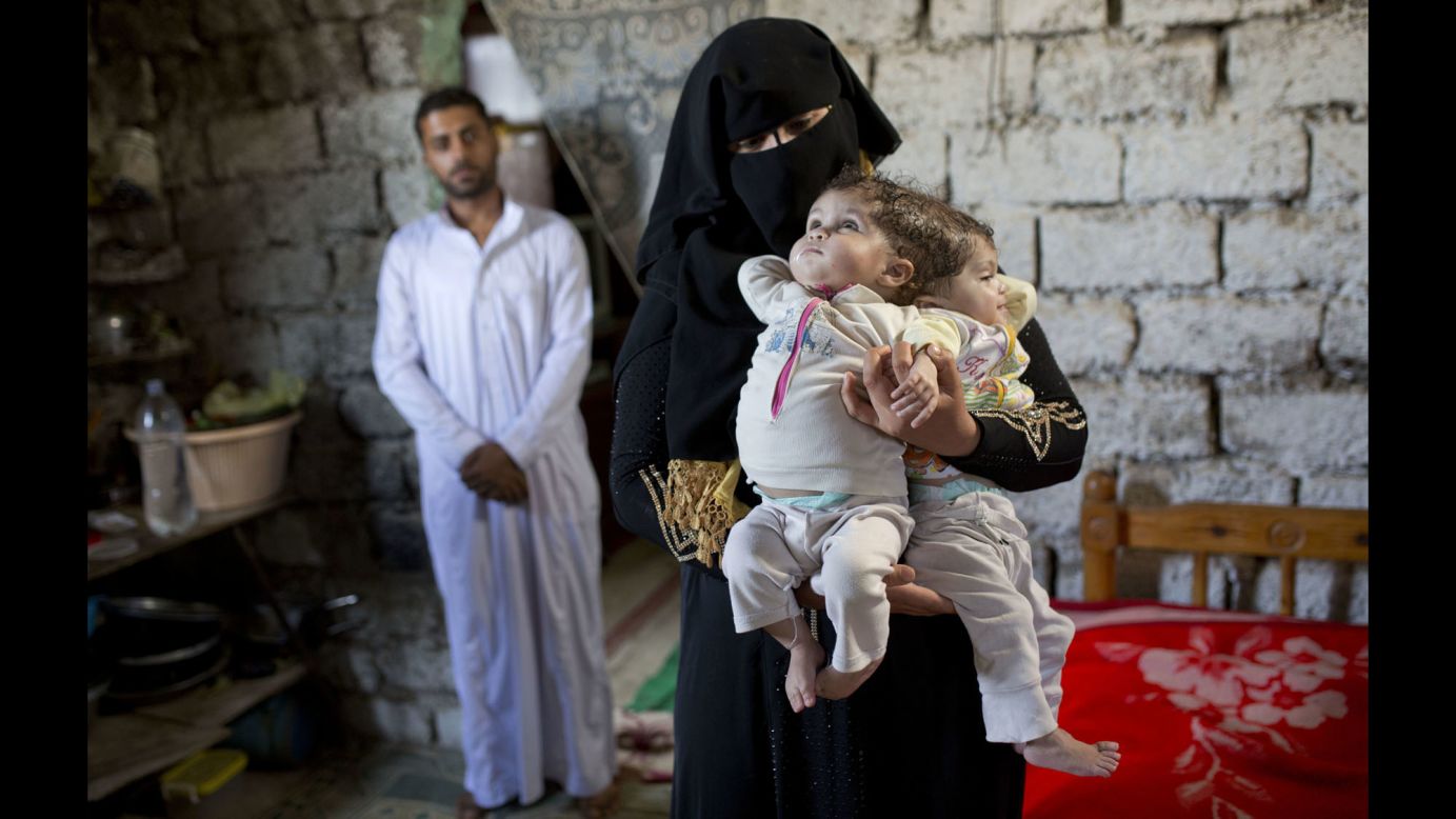 Fatma Yousry holds her conjoined twins -- Menna, left, and Mai -- at their home in Sadat City, Egypt, on Friday, April 22. Yousry and her husband, Islam Hassan, said they had been unable to find treatment for their daughters.