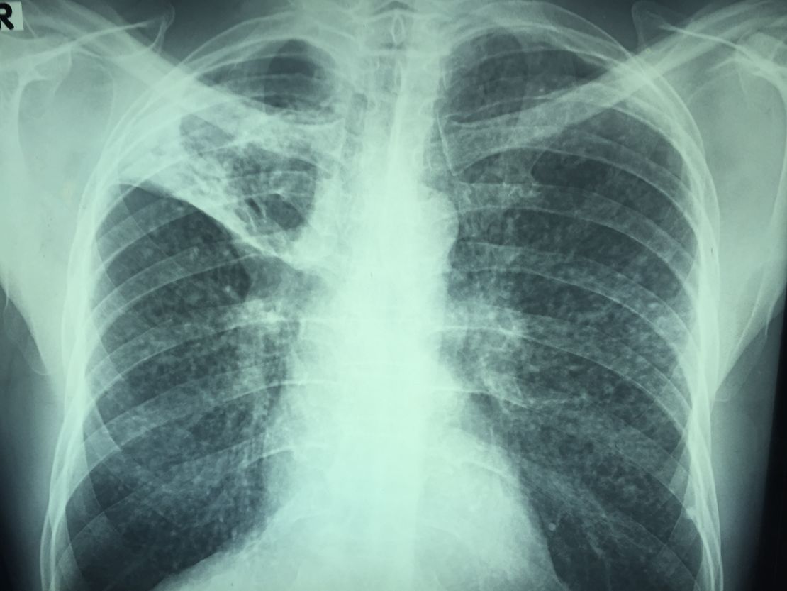 The X-ray of a miner with terminal silicosis showing dust particles embedded deep in the lungs.
