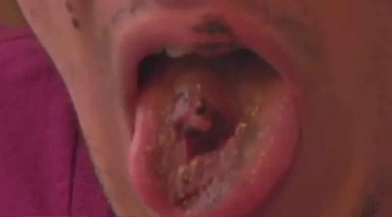 Hole ripped in vaping man s tongue