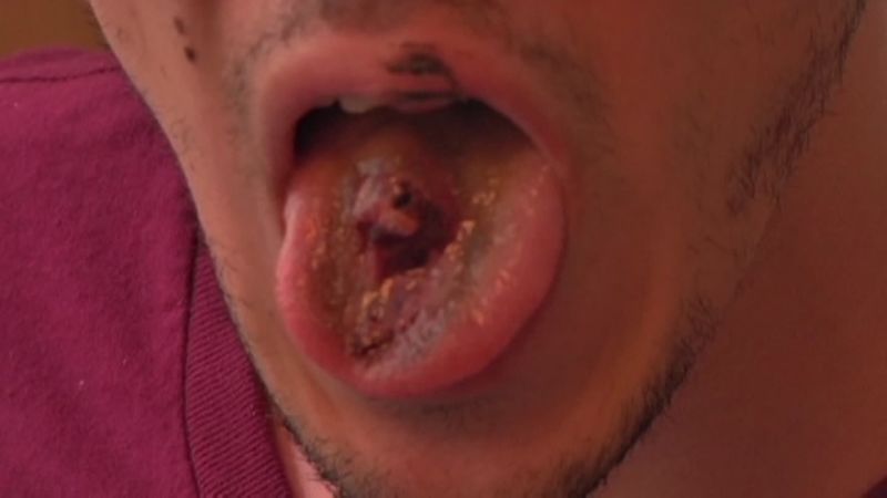 Hole ripped in vaping man s tongue