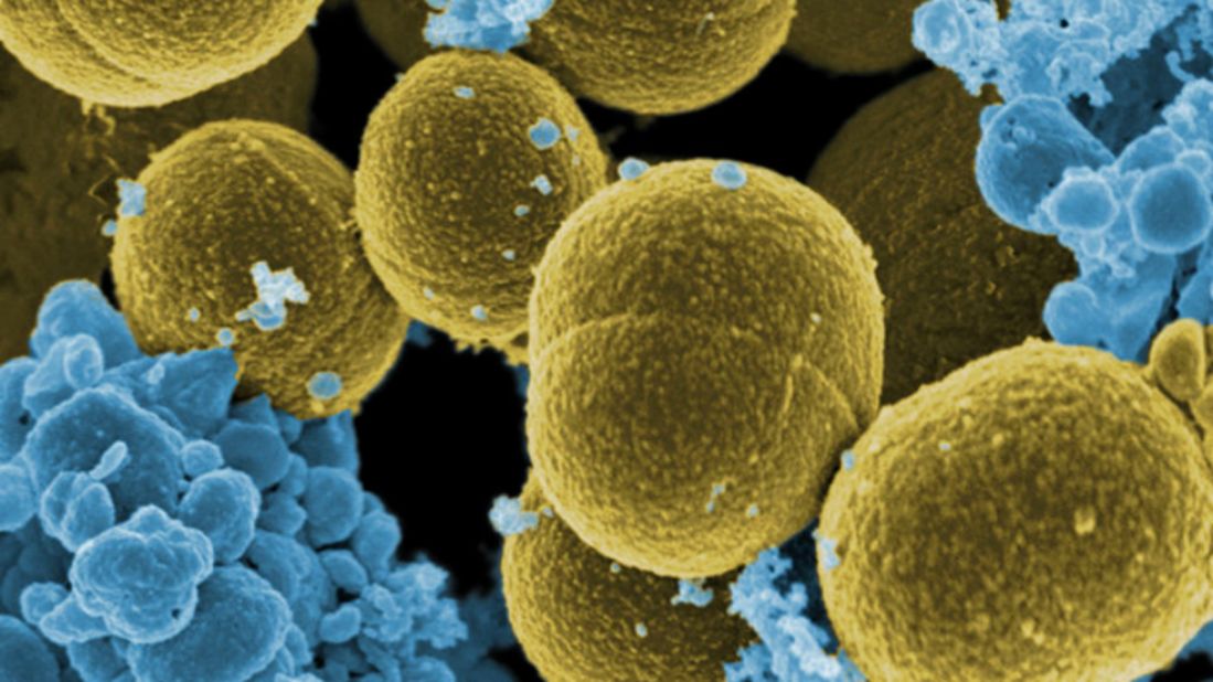 Staphylococcus aureus (staph) is a common type of bacteria which is often found on the skin, in nostrils and in the throat. <a href="http://www.cdc.gov/mrsa/tracking/" target="_blank" target="_blank">According to the CDC,</a> one in three people carries it in their nose without being affected by it. It can cause mild infections of the skin, but if the bacteria gets into the bloodstream it hast the potential to become life threatening by poisoning blood.<br /><br />Multidrug-resistant Staphylococcus aureus (MRSA) has been a concern for many years in hospitals.  People with infected with this form of the bacteria are estimated to be <a href="http://www.who.int/mediacentre/factsheets/fs194/en/" target="_blank" target="_blank">64% more likely</a> to die than people with a non-resistant form of the infection.