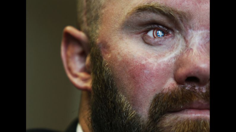 Retired Army Sgt. Thomas Block lost his right eye in Afghanistan in 2013, but he got a prosthetic that resembles the shield of comic-book hero Captain America. He's also part of <a href="index.php?page=&url=http%3A%2F%2Fwww.cnn.com%2F2016%2F02%2F29%2Fus%2Ffreedom-project-hero-corps%2F" target="_blank">the HERO program</a> where wounded, injured and ill veterans receive training in computer forensics so that they can join federal agents in tracking child predators online.