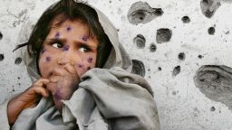 Mahbooba, 7, stands against a bullet-ridden wall waiting to be seen at a health clinic. She suffers from a disfiguring skin disease called Leishmaniasis which is a parasitical bacterial infection transmitted from tiny sand fleas. 
March 1, 2002
