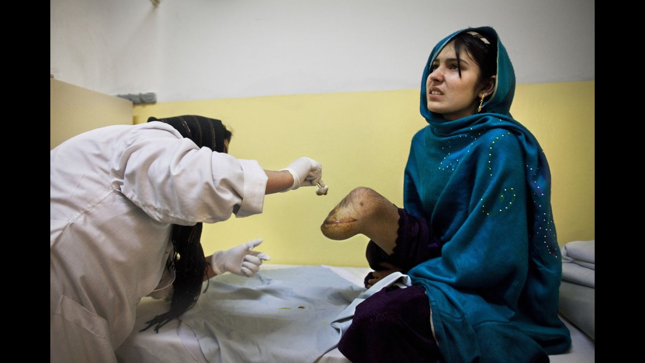 Bibi Adela, 15, is treated at a Red Cross facility in Kabul in November 2009. She lost her leg after a rocket attack that killed her sister and mother.