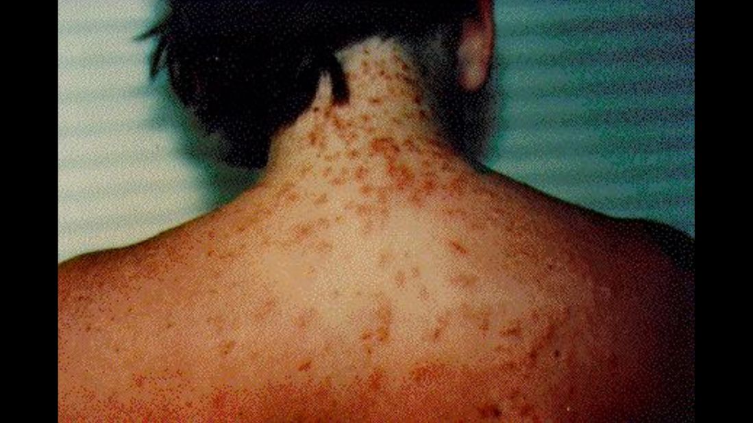 Sea lice, also known as seabather's eruption, can cause an itchy rash.