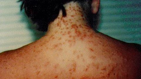 Sea lice, also known as seabather's eruption, can cause an itchy rash.