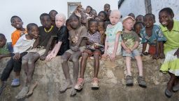 Image of albino children in the community. 