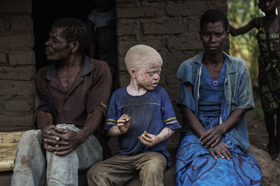 Malawians with albinism -- a genetic condition resulting in little or no pigmentation in the skin, hair and eyes -- are under threat. 
