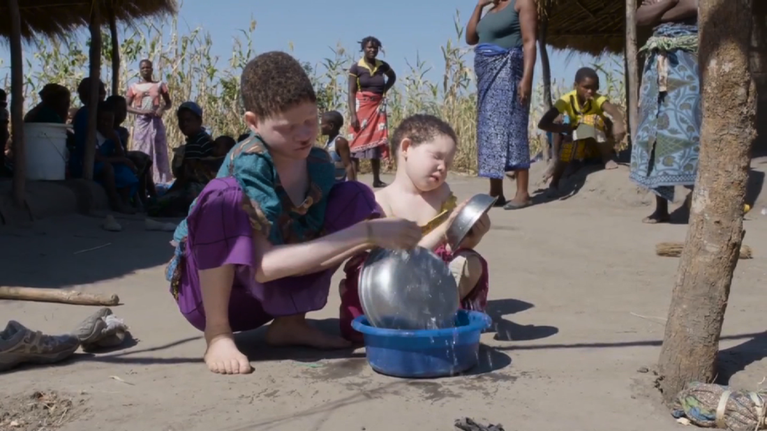 The United Nations warns that Malawi's albinos are at risk of "total extinction."