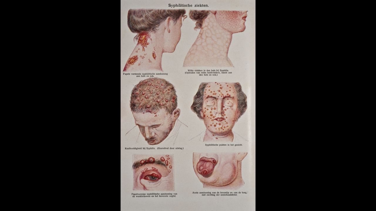 A medical illustration depicts different cases of syphilis. 