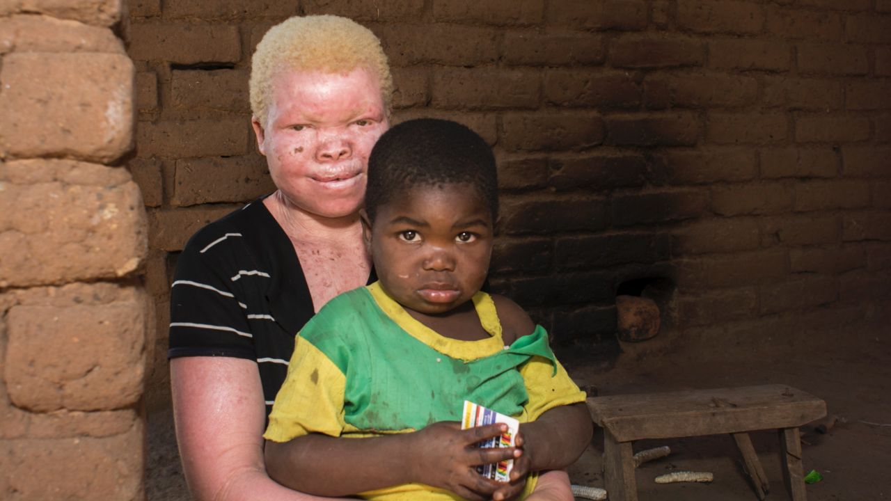 malawi albinos amnesty 2