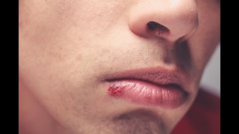 Cold sores or fever blisters are actually the result of the herpes simplex virus. The Centers for Disease Control says that at least half of all Americans are infected with herpes simplex, most of us by the age of 20. Just a quick smooch can give this to your partner or even your children. All they have to do is come into contact with the virus while it's shedding, which can happen even before the telltale blister begins to form. Warning symptoms are mild: an itching, burning or tingling in the area, along with a possible sore throat, fever or swollen glands.