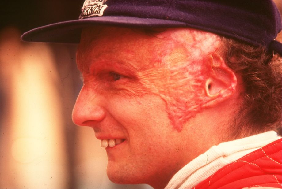 Close to death after inhaling toxic gas and suffering severe burns, Lauda returned to racing just six weeks after the accident -- though he was left with permanent scarring.