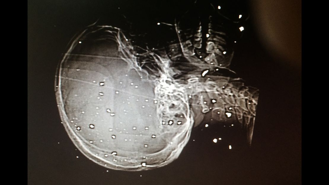 An X-ray showing shrapnel wounds to the skull and spine of a patient.