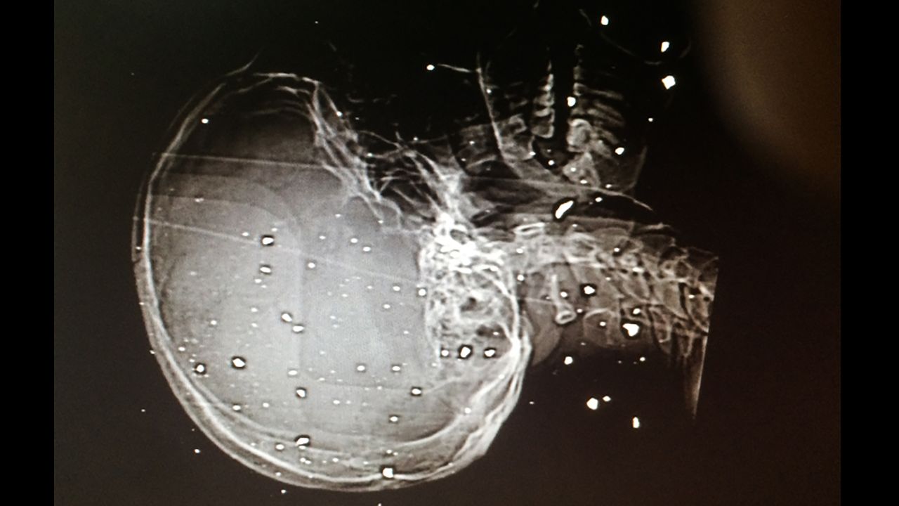 An X-ray showing shrapnel wounds to the skull and spine of a patient.